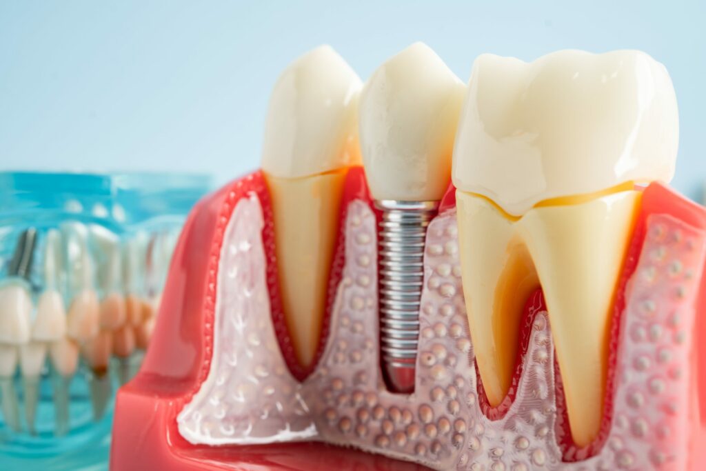 Dental Implants: From Consultation to Final Restoration