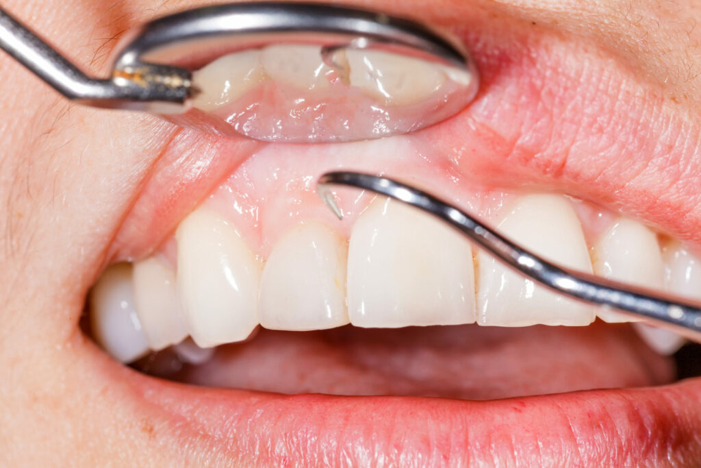 Gum Health and Specialized Periodontal Care: Signs You May Need Periodontal Treatment