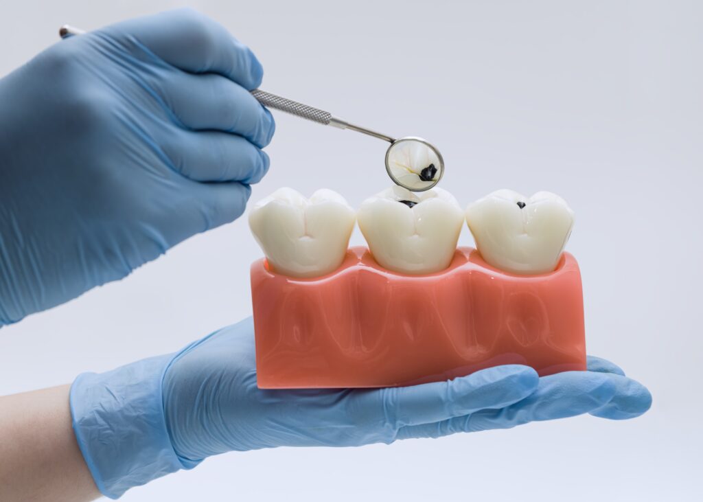 When Your Dentist Says a Cavity Goes Below the Gumline